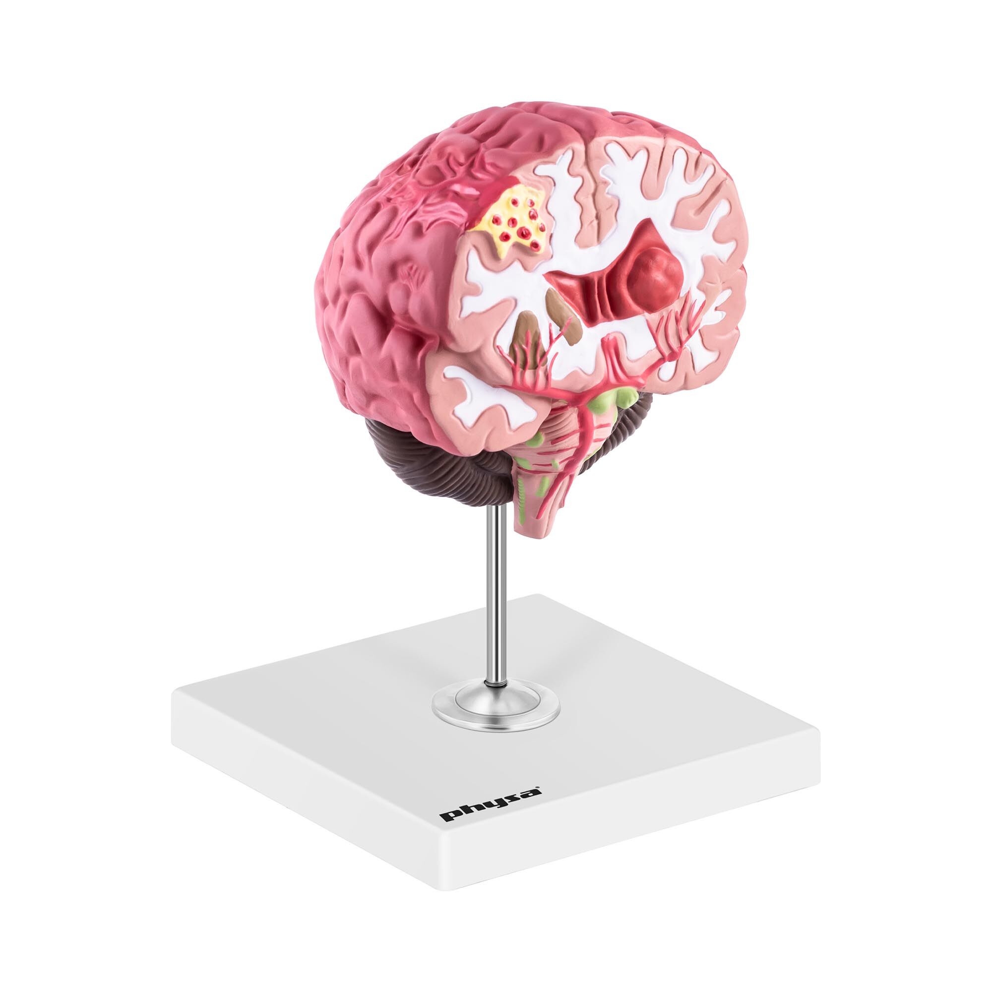 physa Gehirn Modell - pathologisch - koloriert
