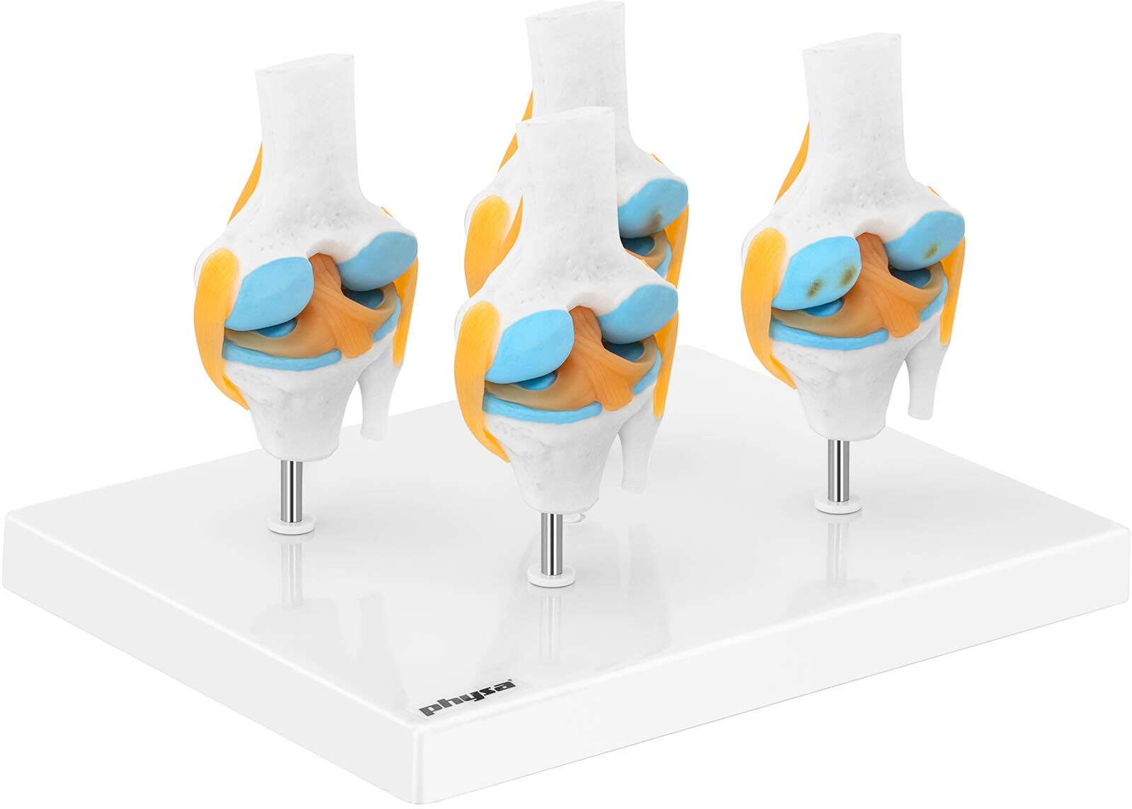 physa Knee Model - 4 stages arthrosis - half scale