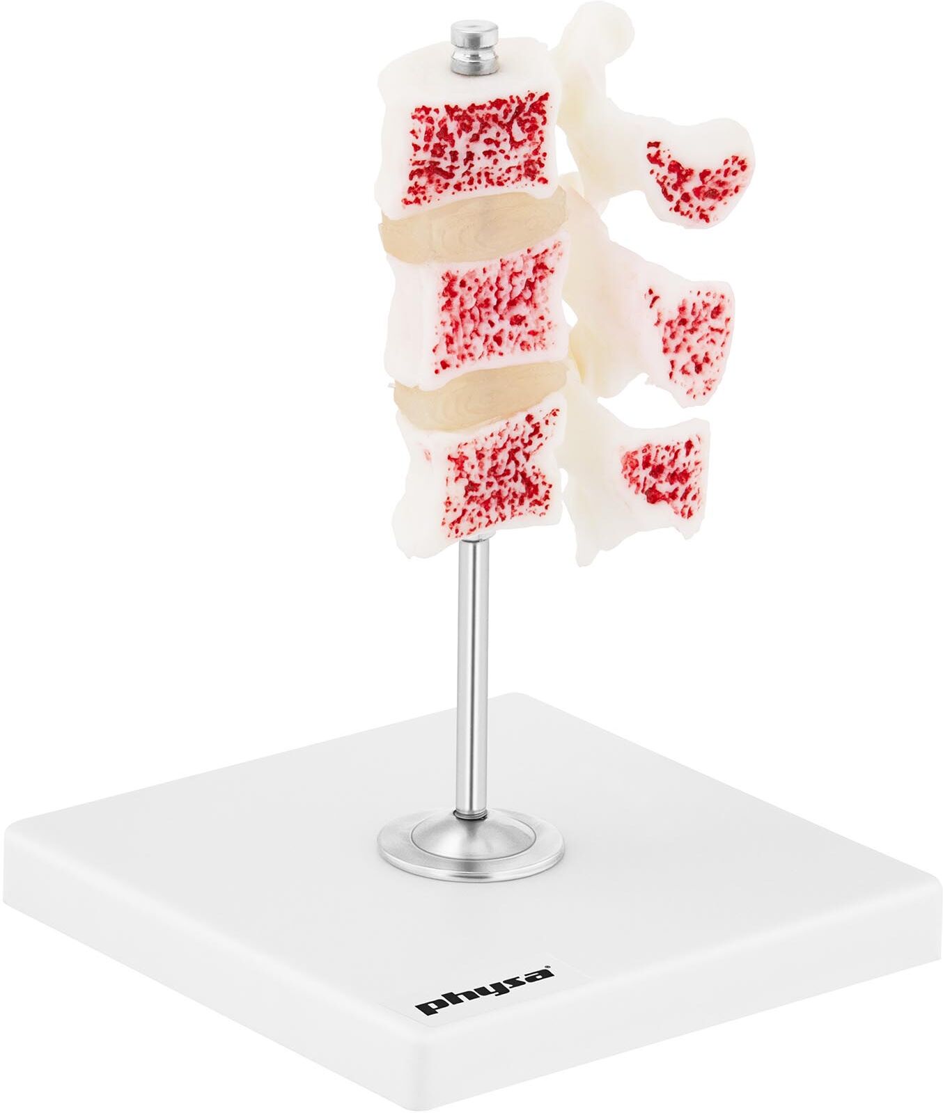 physa Lumbar Vertebra Model - Osteoporosis - Coloured PHY-OM-5