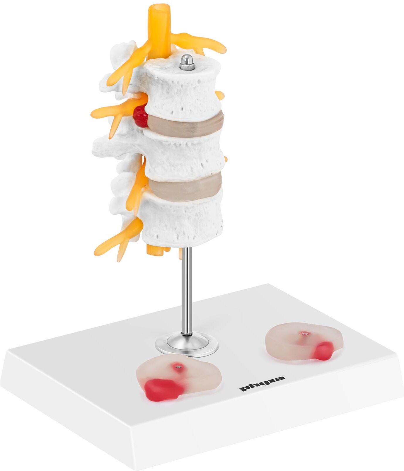 physa Intervertebral Disc Model - Slipped Disc - Coloured PHY-SM-6