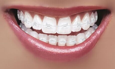 Dental Care London Clear Braces for One or Two Arches at Dental Care London