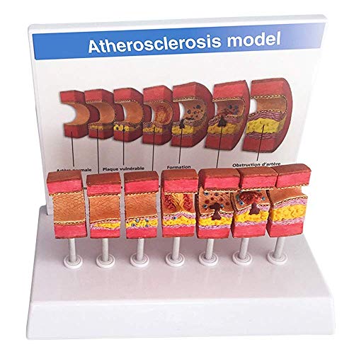 DACUDA Torso- en skeletmodellen Anatomisch, slagader Anatomisch model Anatomisch atherosclerose Trombus Vasculair model