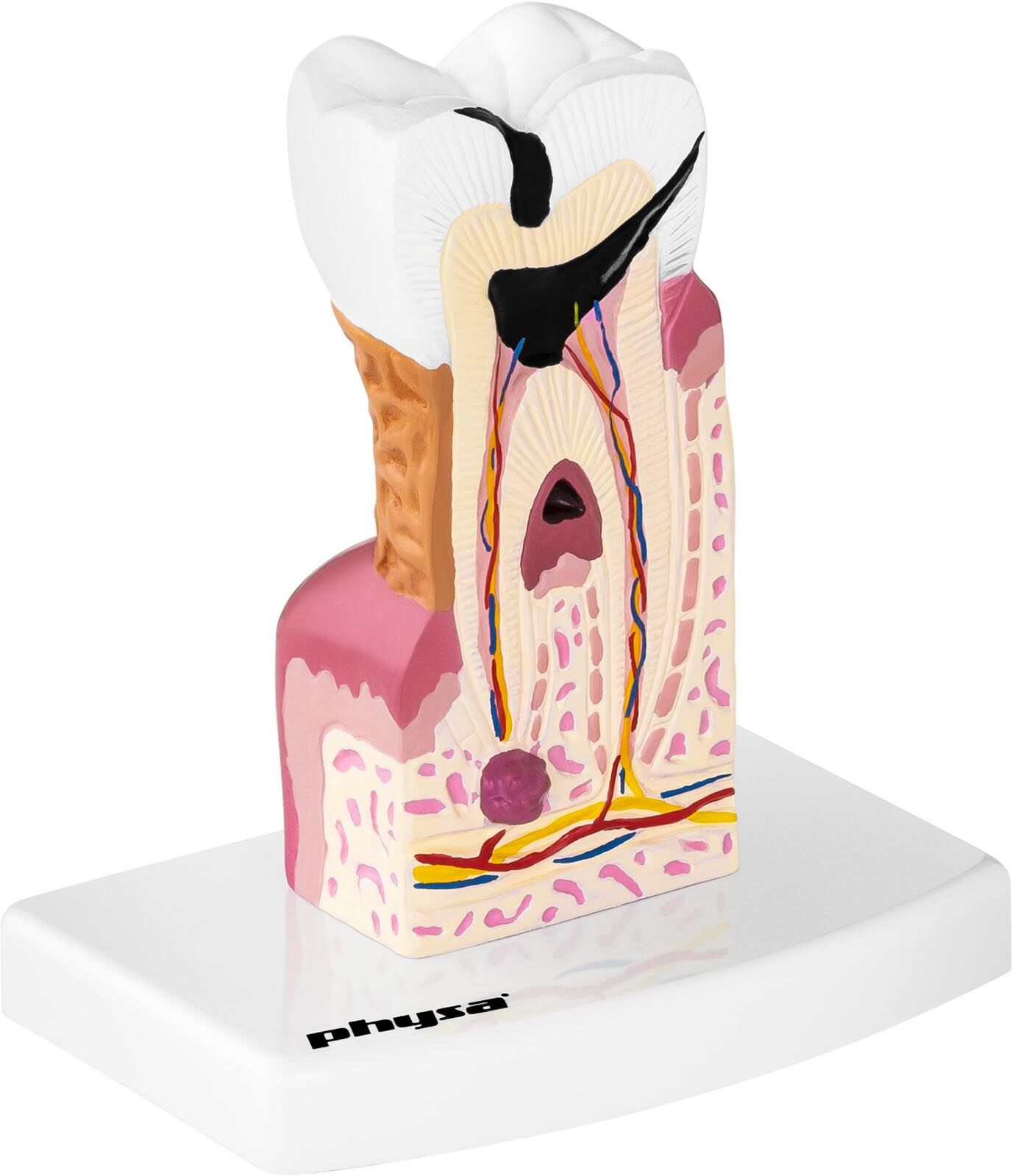 physa Chory ząb - model anatomiczny PHY-TM-1