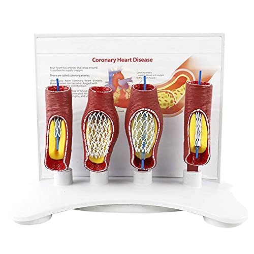 HYCLAM Lichaamsmodel Menselijke Anatomie Modellen, Menselijk Vasculair Stent Model Kransslagader Cardiovasculair Bloedvat Verstopping Beugel Medisch Model, voor Medisch