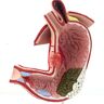 ADLWVP Menselijk orgaan Anatomisch anatomiemodel Menselijke maag Gastritis Model Maaglaesie Model Maagpathologie Gastritis