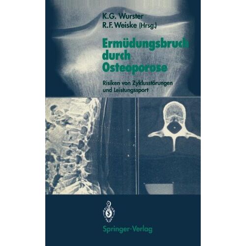 Wurster, Kurt G. – Ermüdungsbruch durch Osteoporose: Risiken von Zyklusstörungen und Leistungssport (German Edition)