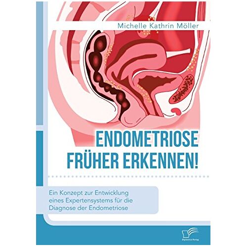 Möller, Michelle Kathrin – Endometriose früher erkennen! Ein Konzept zur Entwicklung eines Expertensystems für die Diagnose der Endometriose