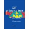 MRI of the Fetal Brain