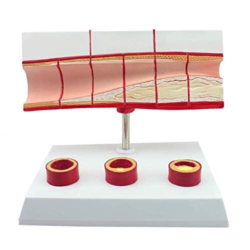 JIANGHA Medische Modellen, Hart-Vasculaire Cholesterol Model Trombose Proces Anatomie Model Coronaire Hartziekte Bloed Cholesterol Hart Anatomisch Model