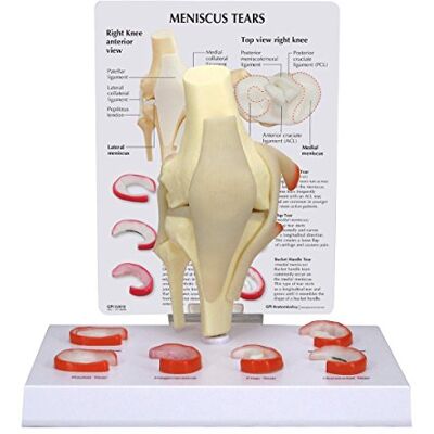 3B Scientific GPI Anatomicals 1010 Genouillère ménisque avec 6 fissures 3B Scientific GPI Anatomicals 1010 Genouillère ménisque avec 6 fissures