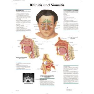 3B Scientific Lehrtafel Rhinitis und Sinusitis 3B Scientific Lehrtafel Rhinitis und Sinusitis