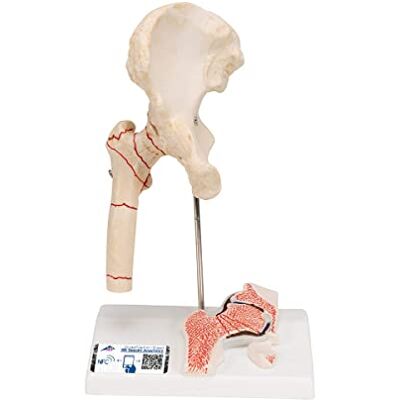 3B Scientific Lidská anatomie – zlomenina stehna a opotřebení kyčelního kloubu + bezplatná anatomie aplikace – 3B Smart Anatomy 3B Scientific Lidská anatomie – zlomenina stehna a opotřebení kyčelního kloubu + bezplatná anatomie aplikace – 3B Smart Anatomy