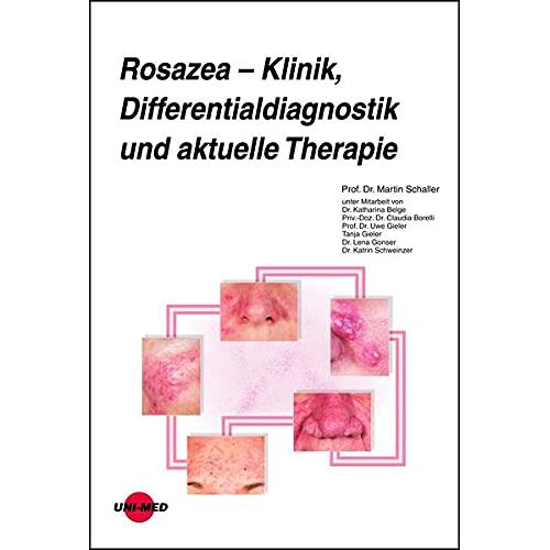 Martin Schaller – GEBRAUCHT Rosazea – Klinik, Differentialdiagnostik und aktuelle Therapie (UNI-MED Science) – Preis vom 08.01.2024 05:55:10 h