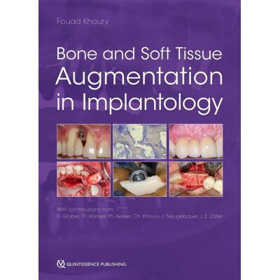 Quintessenz Verlag Bone And Soft Tissue Augmentation In Implantology Quintessenz Verlag Bone And Soft Tissue Augmentation In Implantology