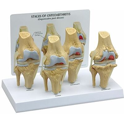 3B Scientific GPI Anatomicals 1100 Osteo-Kniemodellset 4 verschiedener Stadien 3B Scientific GPI Anatomicals 1100 Osteo-Kniemodellset 4 verschiedener Stadien