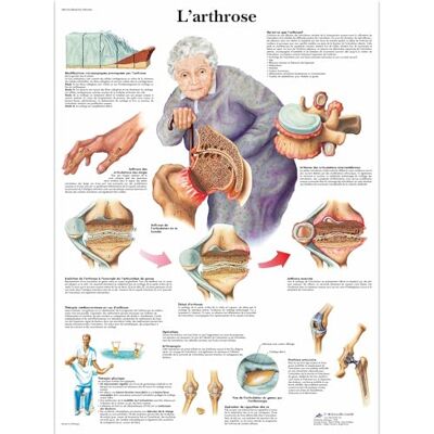 3B Scientific – Laminierte Osteoarthritis Tafel – UV- & Staubgeschütztes Anatomie & Pathologie Poster für Studium, Lehre & Kliniken 3B Scientific – Laminierte Osteoarthritis Tafel – UV- & Staubgeschütztes Anatomie & Pathologie Poster für Studium, Lehre & Kliniken
