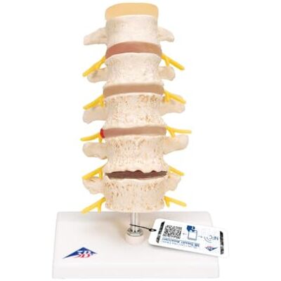 3B Scientific ® Lendenwirbelsäulenmodell – Lebensgroße Lendenwirbel mit Stadien von Bandscheibenvorfall & Wirbeldegeneration + 3B Smart Anatomy App 3B Scientific ® Lendenwirbelsäulenmodell – Lebensgroße Lendenwirbel mit Stadien von Bandscheibenvorfall & Wirbeldegeneration + 3B Smart Anatomy App