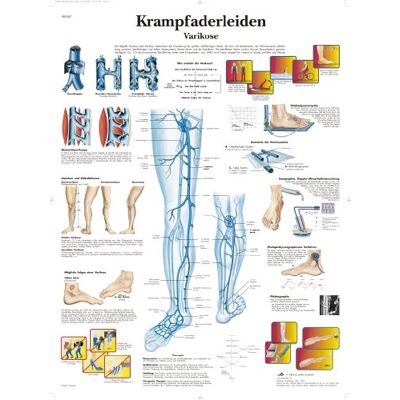 3B Scientific - Kalibriertes Laminierbrett - Varizen - Poster 3B Scientific - Kalibriertes Laminierbrett - Varizen - Poster