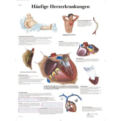 3B Scientific Lehrtafel Häufige Herzerkrankungen 3B Scientific Lehrtafel Häufige Herzerkrankungen