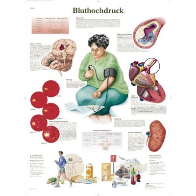 3B Scientific Lehrtafel laminiert Bluthochdruck 3B Scientific Lehrtafel laminiert Bluthochdruck