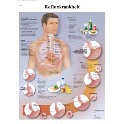3B Scientific - Refluxkrankheiten Laminitiert - Poster 3B Scientific - Refluxkrankheiten Laminitiert - Poster