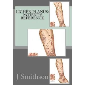 J. P. Smithson Ma Lichen Planus