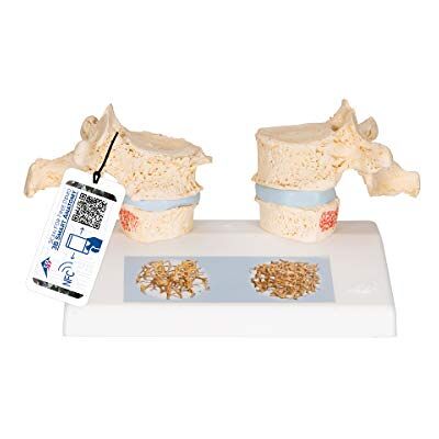 3B Scientific Disco de Cabeza de Incidente de Osteoporosis - Modelo Anatómico 3B Scientific Disco de Cabeza de Incidente de Osteoporosis - Modelo Anatómico