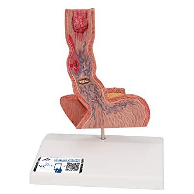 3B Scientific Modelo de anatomía humana Enfermedades del Esófago + App de anatomía gratuita 3B Smart Anatomy 3B Scientific Modelo de anatomía humana Enfermedades del Esófago + App de anatomía gratuita 3B Smart Anatomy