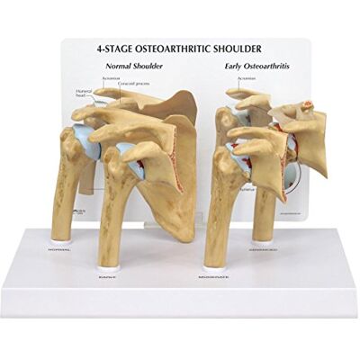 3B Scientific GPI Anatomicals Modelo de hombro con osteoartritis (OA), 4 fases 3B Scientific GPI Anatomicals Modelo de hombro con osteoartritis (OA), 4 fases