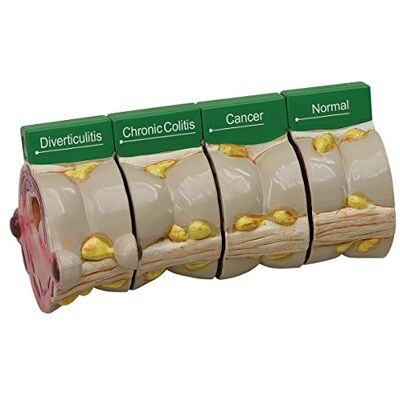 3B Scientific GPI Anatomicals Colon de 4 piezas con patologías 3B Scientific GPI Anatomicals Colon de 4 piezas con patologías