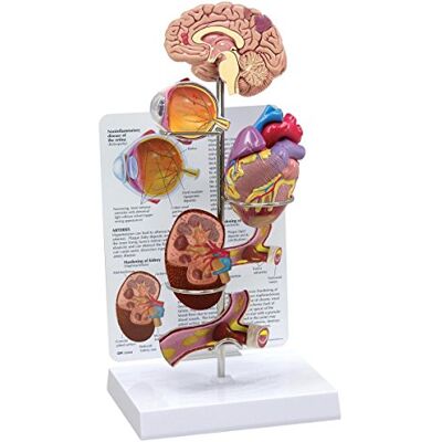 3B Scientific GPI Anatomicals Conjunto de hipertensión 3B Scientific GPI Anatomicals Conjunto de hipertensión