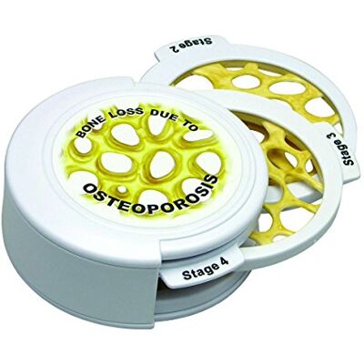 3B Scientific GPI Anatomicals Conjunto de discos de cáncer de hueso – 4 fases de la osteoporosis 3B Scientific GPI Anatomicals Conjunto de discos de cáncer de hueso – 4 fases de la osteoporosis