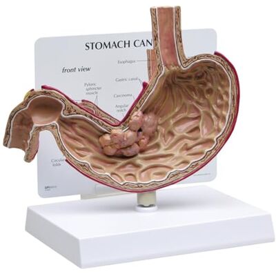 3B Scientific GPI Anatomicals 2001 Modelo de Cáncer de Estómago 3B Scientific GPI Anatomicals 2001 Modelo de Cáncer de Estómago