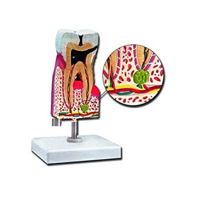 GIMA Modelo Molari inferiores con caries, Unidades 1 Unidad GIMA Modelo Molari inferiores con caries, Unidades 1 Unidad