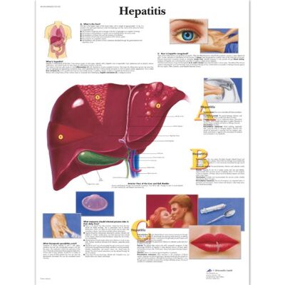 3B Scientific Tabla De Hepatitis, Laminado, 1 3B Scientific Tabla De Hepatitis, Laminado, 1