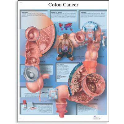 3B Scientific Tabla calculadora científica Colon Cáncer de Mama diseño con la escala de 3B Scientific Tabla calculadora científica Colon Cáncer de Mama diseño con la escala de