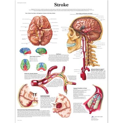 3B Scientific – Lámina Plastificada del Accidente Cerebrovascular – Póster de Anatomía y Patología Protegido contra UV y Polvo para Estudio, Enseñanza y Clínicas 3B Scientific – Lámina Plastificada del Accidente Cerebrovascular – Póster de Anatomía y Patología Protegido contra UV y Polvo para Estudio, Enseñanza y Clínicas