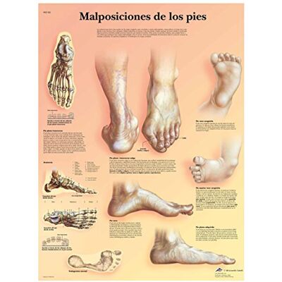 3B Scientific VR3185L Póster anatómico, Mal posiciones de los pies 3B Scientific VR3185L Póster anatómico, Mal posiciones de los pies