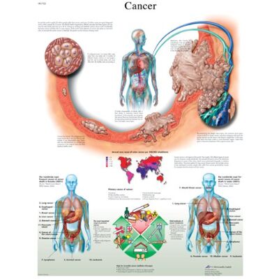 3B Scientific Temporada educativa laminada Cancer Inglés 3B Scientific Temporada educativa laminada Cancer Inglés