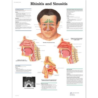 3B Scientific Anatomía humana Rinitis y Sinusitis, versión laminada 3B Scientific Anatomía humana Rinitis y Sinusitis, versión laminada