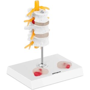 physa Maquette anatomique des disques intervertebraux - Hernie discale lombaire - En couleurs PHY-SM-6