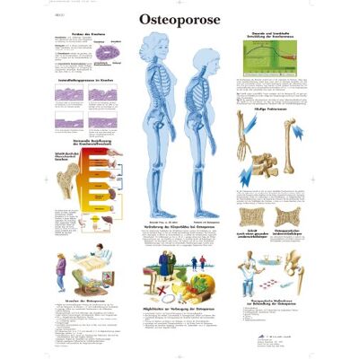 3B Scientific kalibrált laminált tábla - Osteoporosis 3B Scientific kalibrált laminált tábla - Osteoporosis