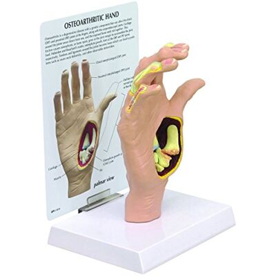 3B Scientific GPI Anatomicals 1930 Modello di Mano con Osteoartrite 3B Scientific GPI Anatomicals 1930 Modello di Mano con Osteoartrite