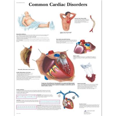 3B Scientific Comon Disordini Cardiaci Grafico, Laminato., 1 3B Scientific Comon Disordini Cardiaci Grafico, Laminato., 1