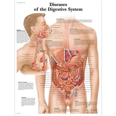 3B Scientific malattie del sistema digestivo Chart, unlaminated 3B Scientific malattie del sistema digestivo Chart, unlaminated