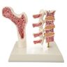 Fyearfly Modello di Lesione Dell'osteoporosi, Modello della Colonna Vertebrale Dell'osteoporosi Che Dimostra Il Modello Educativo della Lesione Dell'osteoporosi Per L'insegnamento Clinico