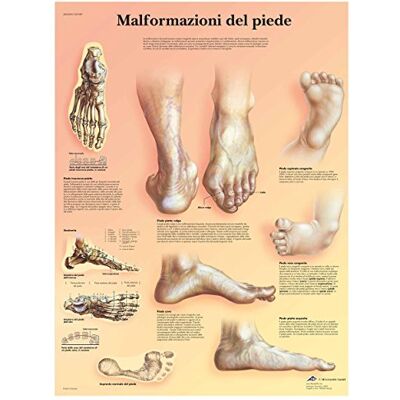 3B Scientific VR4185L Malformazioni di Piede 3B Scientific VR4185L Malformazioni di Piede