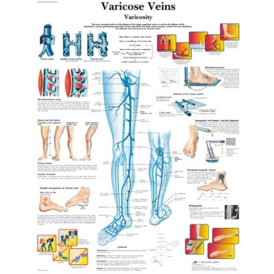 3B Scientific vene varicose grafico, laminated, 1 3B Scientific vene varicose grafico, laminated, 1