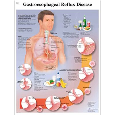 3B Scientific Anatomia umana Grafico della malattia da reflusso gastroesofageo, versione cartacea 3B Scientific Anatomia umana Grafico della malattia da reflusso gastroesofageo, versione cartacea