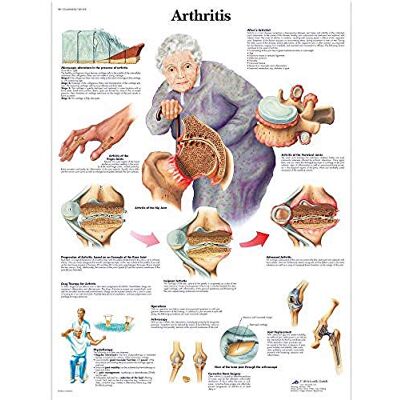 3B Scientific Anatomia umana Artrite Grafico, Versione Carta 3B Scientific Anatomia umana Artrite Grafico, Versione Carta